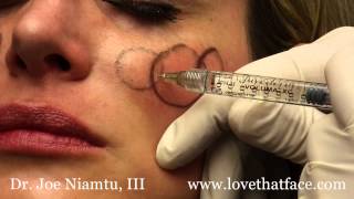 Juverderm Voluma 5 Minute Cheeks by Dr Joe Niamtu III [upl. by Dlarej924]