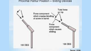 Biomechanics of Hip Osteotomies [upl. by Hellman]