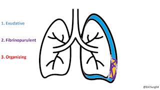 Empyema and Pleural Effusions [upl. by Danice903]