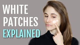 WHITE PATCHES ON THE FACE EXPLAINED PITYRIASIS ALBA DR DRAY [upl. by Menendez345]