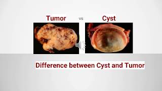 Difference between Cyst and Tumor [upl. by Sucitivel]