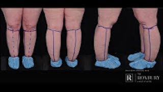 What is Lipedema [upl. by Farman]