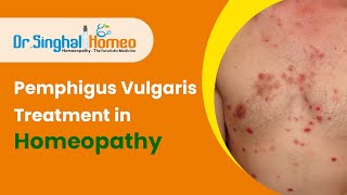 Best Homeopathic Treatment for Pemphigus Vulgaris  Dr Singhal Homeo [upl. by Teragramyram]