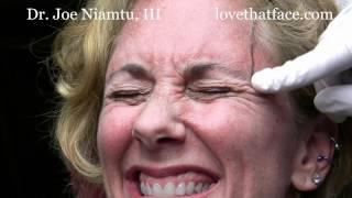 Botox Browlift by Dr Joe Niamtu III [upl. by Marte]