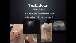 US Guided thoracentesis CUSE 2018 [upl. by Henley516]