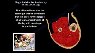 Single Incision For Fasciotomy Of The Leg  Everything You Need To Know  Dr Nabil Ebraheim [upl. by Nasho]