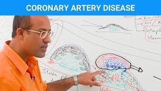 Coronary Artery Disease  Ischemic Heart Disease  Angina🫀 [upl. by Aihsela]