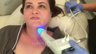 BTL Exilis Ultra  Neck Lift Skin Tightening  Cellulite Reduction  Beverly Hills [upl. by Glantz]