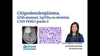 Oligodendroglioma IDH1mutant 1p19q codeleted [upl. by Bouldon]