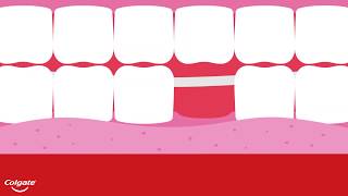 The Four Types of Dental Bridges [upl. by Kenwood]