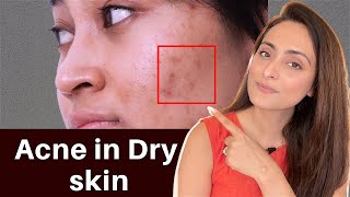 How to use Benzoyl Peroxide gel Dr Ashima Goel Parisa Skin clinic Acne Treatment in Chandigarh [upl. by Inge]