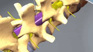 What to expect during an Epidural Steroid Injection at RAYUS [upl. by Charbonnier]