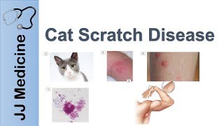 Cat Scratch Disease  Causes Symptoms and Treatment [upl. by Telrats]