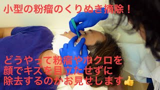 粉瘤のくり抜き摘除【皮膚科専門医が解説！】小型の粉瘤を2ミリパンチで縫わずにとります [upl. by Akitan384]