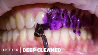 How Teeth Are Professionally Deep Cleaned  Deep Cleaned [upl. by Edric]