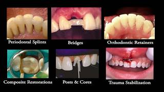 What is Ribbond Features Benefits FAQ’s [upl. by Golter]