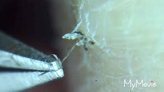 pLuCkInG Ingrown Hair in Satisfying Compilation [upl. by Ettennig565]