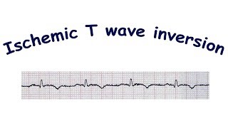 Mechanism of ischemic T wave inversion [upl. by Cyndi]