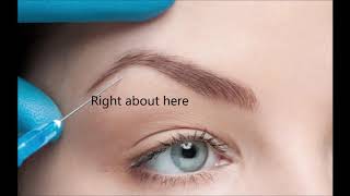 Botox for Nose  Nasal Tip Lift  San Diego Botox Injections [upl. by Omidyar309]