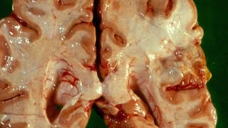 Cerebral Ischaemia and Infarction  Pathology mini tutorial [upl. by Mellen]