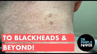 To Blackheads amp Beyond [upl. by Ellswerth]