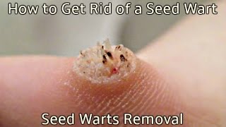 How to Get Rid of a Seed Wart  Seed Warts Removal [upl. by Leitman847]