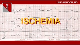 ECG Ischemia [upl. by Hank]