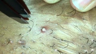 INFECTED INGROWN HAIR 05 [upl. by Sedgewick]