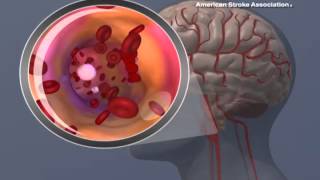 Ischemic Stroke Animation [upl. by Chapen]