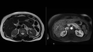 Renal Oncocytoma [upl. by Podvin321]