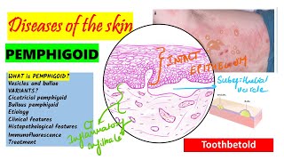 Pemphigoid Causes pathogenesis Types Histopathology Treatment  Pemphigus vs Pemphigoid [upl. by Eudocia]