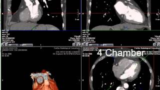 Coronary CT Angiography RCA Stenosis [upl. by Aivil]