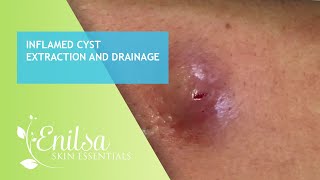 Inflamed Cyst Extraction and Drainage [upl. by Bram125]