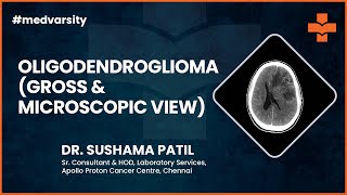 Oligodendroglioma Gross amp Microscopic View  MedvarsityOnlineLtd [upl. by Lange430]