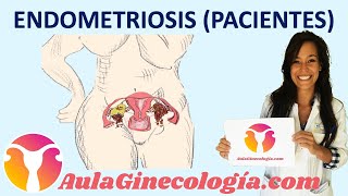 ENDOMETRIOSIS PACIENTES Síntomas diagnóstico tratamiento fertilidad Ginecología y Obstetricia [upl. by Ateiram737]