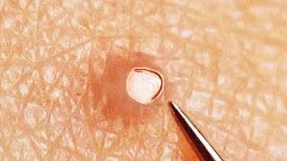 Ingrown Hair Removal On Leg [upl. by Aiym]