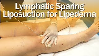 Lymphedema Massage Full Manual Lymphatic Drainage Massage for LEFT ARM Lymphedema [upl. by Roane]