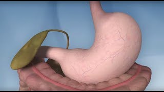 Scarless Revision Surgery after Gastric Bypass [upl. by Thgiwd679]