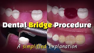 Dental Bridge Procedure [upl. by Tecu]