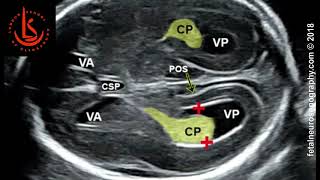 Fetal lateral ventricle measurements How to measure posterior ventricle for ventriculomegaly [upl. by Esilrahc]