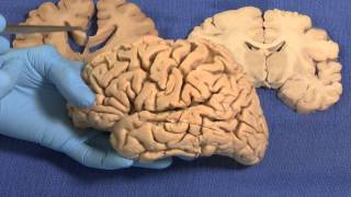 Limbic Neuroanatomy Video Lab  Brain Dissections [upl. by Aires]