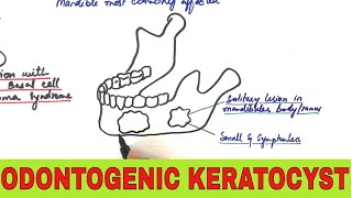 Odontogenic Keratocyst  Clinical Radiographic and Histopathologic Features [upl. by Aara941]