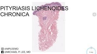 Pityriasis Lichenoides Chronica Dermpath Made Easy [upl. by Laehcor196]