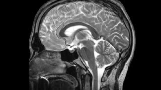 The Ventricles Neuroanatomy Video Lab  Brain Dissections [upl. by Pete]